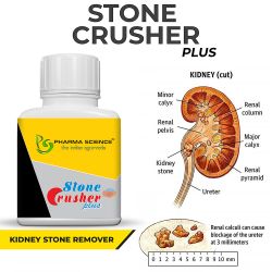 Pharma Science Stone Crusher Plus Ayurvedic Medicine for Kidney Stone -Pack of 1