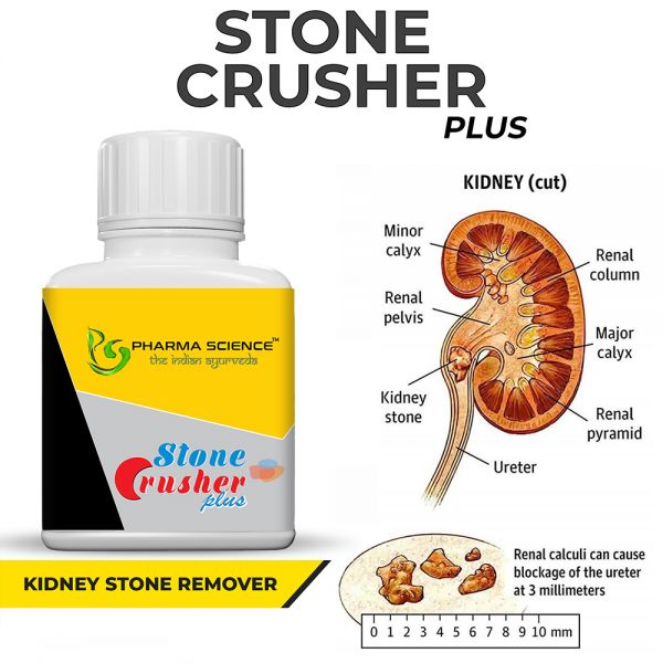 Pharma Science Stone Crusher Plus Ayurvedic Medicine for Kidney Stone -Pack of 1